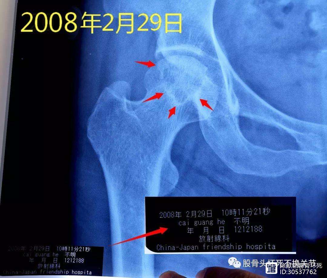 兰州人工骨头医保报销多少(人工骨头医保报销多少比例)
